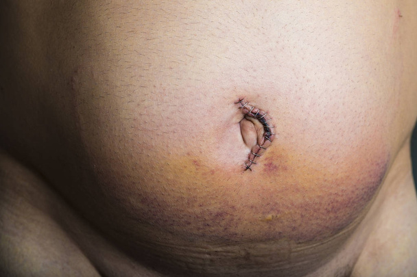 Hérnia umbilical cirurgia de reparação
 - Foto, Imagem