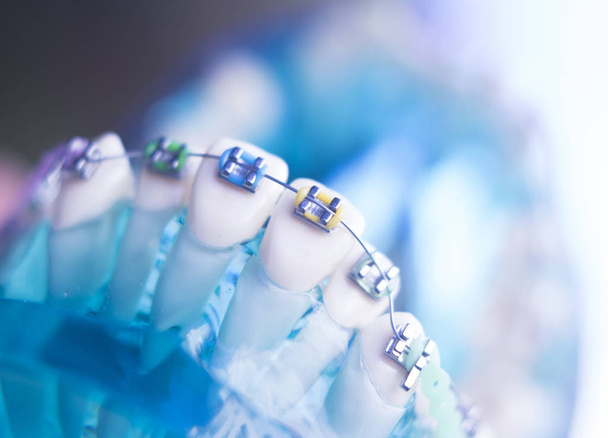 Zamki metalowe zębów dentystycznych - Zdjęcie, obraz