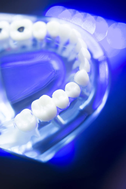 Zubní modelu zubní kaz - Fotografie, Obrázek