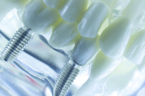 Implants dentaires en titane
 - Photo, image