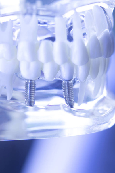 Dentsts dental tooth implant - Photo, Image