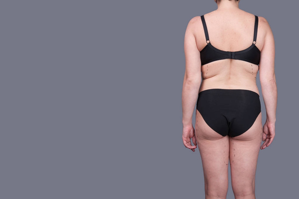 Woman in underwear with marks for plastic surgery - Φωτογραφία, εικόνα