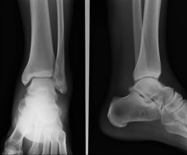 x-ray boka ap oldalsó - Fotó, kép