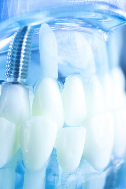 Dental titanium tooth implant - Photo, Image