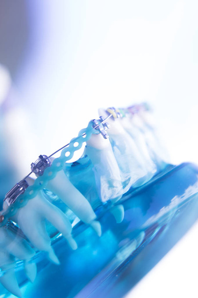 Tandheelkundige tanden metalen haken - Foto, afbeelding