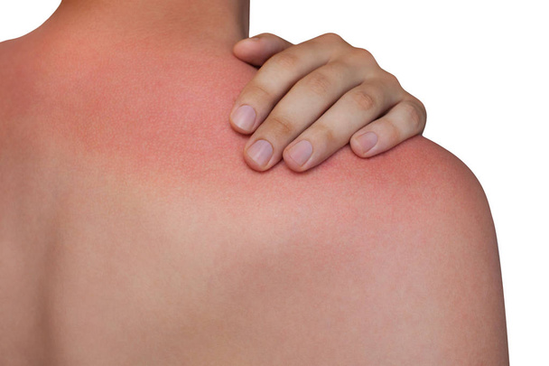 A man with reddened, itchy skin after sunburn on white isolated background - Photo, Image