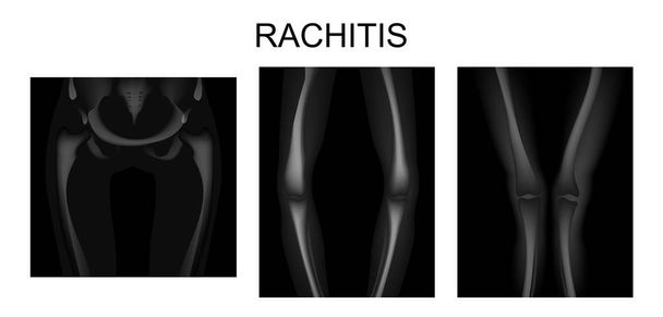 el esqueleto de las extremidades inferiores en raquitismo
 - Vector, Imagen