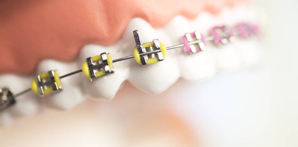 Косметичні металеві кронштейни для зубів
 - Фото, зображення