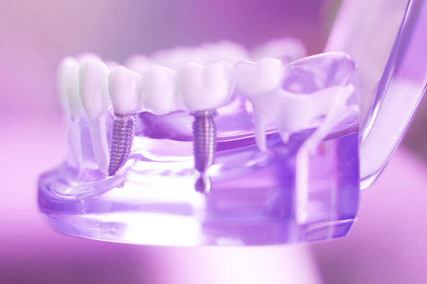 Dentsts diş implant diş - Fotoğraf, Görsel