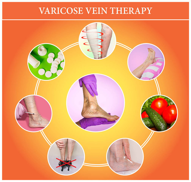 Treatment of varicose veins - Photo, Image