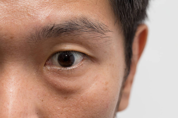 asiático hombre cara grasa piel con gran ojo bolsa en el ojo izquierdo
 - Foto, imagen