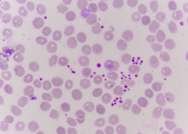 thrombocyta megszilárduló, mint egy lehetséges oka az alacsony vérlemezke szám, p - Fotó, kép