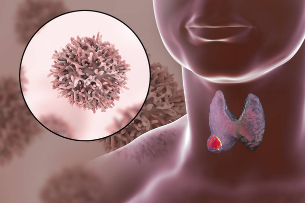 Ilustración del cáncer de tiroides
 - Foto, Imagen