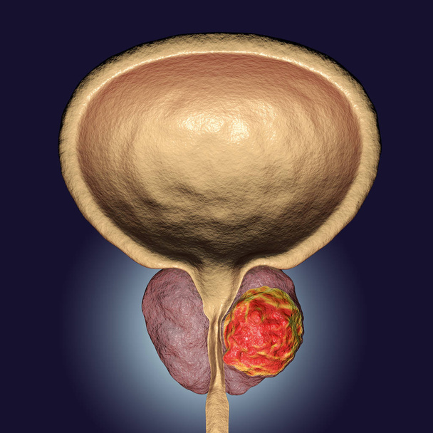 Ilustração do câncer de próstata
 - Foto, Imagem