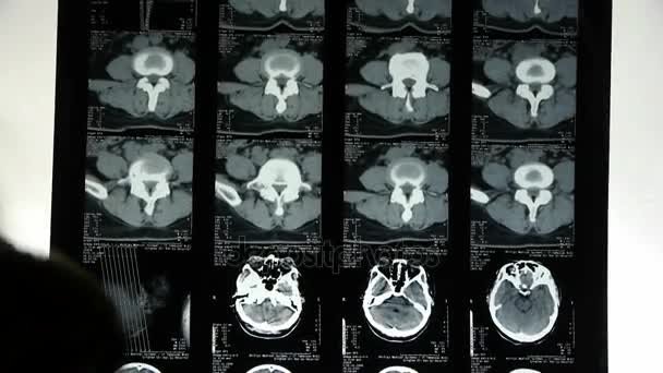 Artsen onderzoeken schedel hersenen X-ray film voor analysis.cerebellum,brainstem. - Video