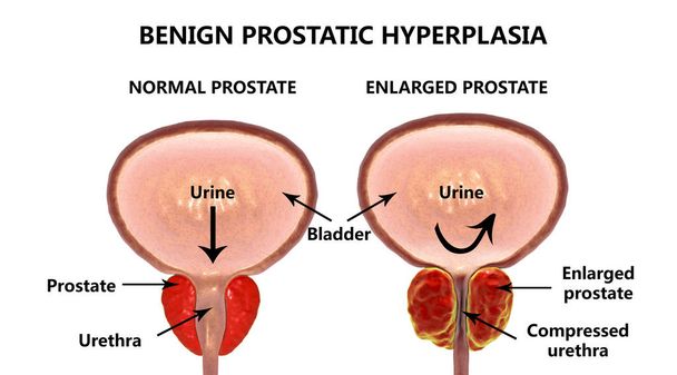 hiperplasia benigna da próstata
 - Foto, Imagem