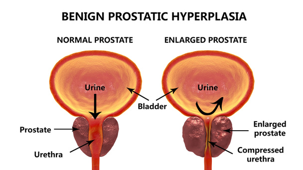 Goedaardige prostatic hyperplasia - Foto, afbeelding