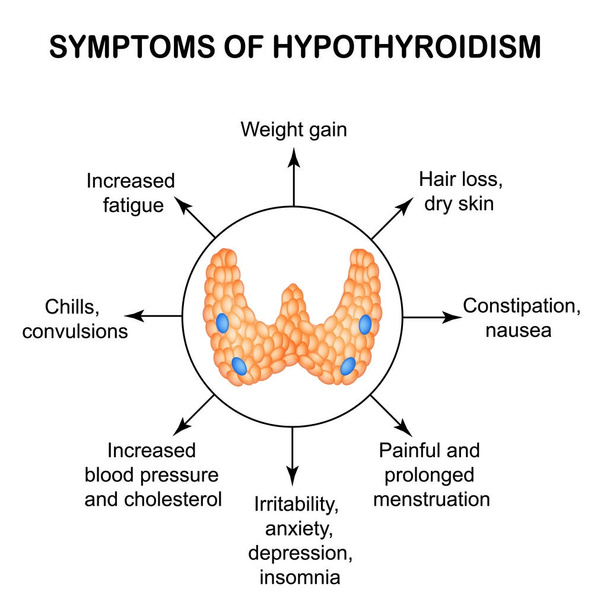 Symptômes de l'hypothyroïdie. Thyroïde. Infographie. Illustration vectorielle sur fond isolé
. - Vecteur, image