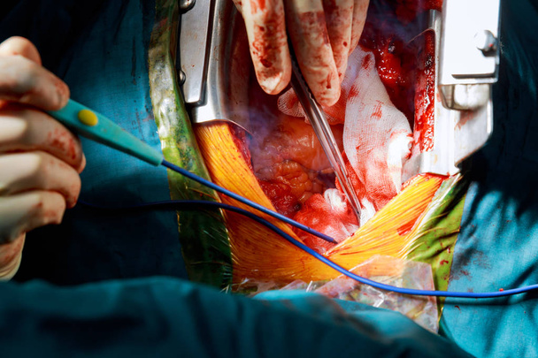 abordaje quirúrgico mínimamente invasivo con una pequeña incisión para cirugía valvular cardíaca
 - Foto, imagen