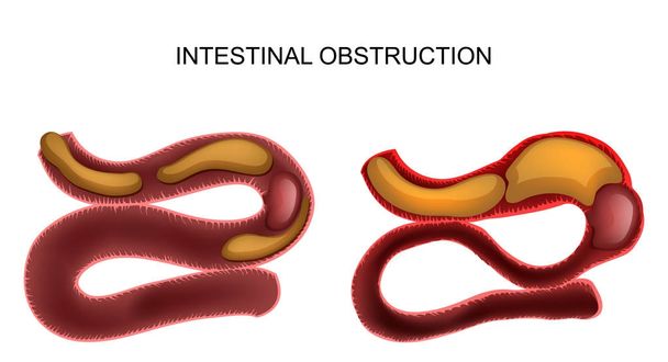 bél obstruction.abdominal műtét - Vektor, kép