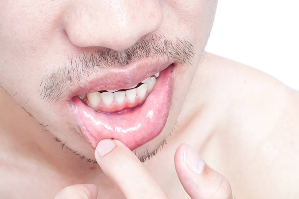 Close up of lips man problem health care, Herpes simplex
 - Фото, изображение