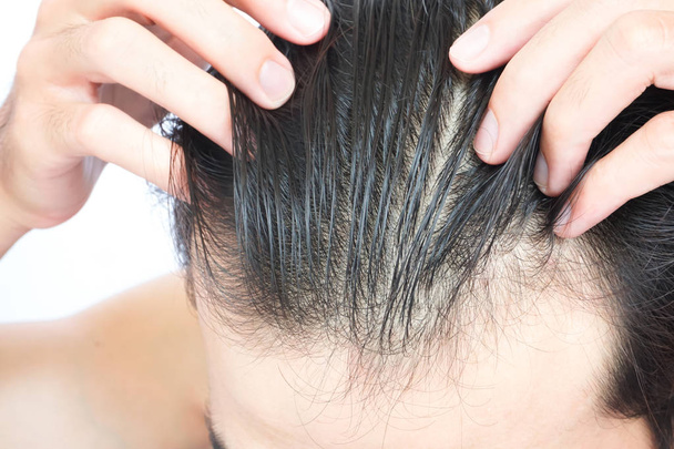Молодой человек серьезная проблема выпадения волос для здравоохранения медицинской концепции и шампуня продукт - Фото, изображение