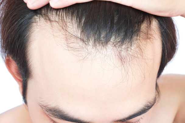 Молодой человек серьезная проблема выпадения волос для здравоохранения медицинской концепции и шампуня продукт - Фото, изображение