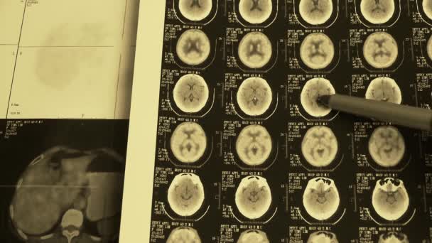 doctor study color head & vertebral pet-ct,skull brain X-ray. - Footage, Video