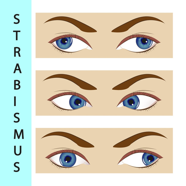 Estrabismo estrabismo, ojo, ilustración, trastorno, movimiento, oftalmólogo
, - Vector, imagen