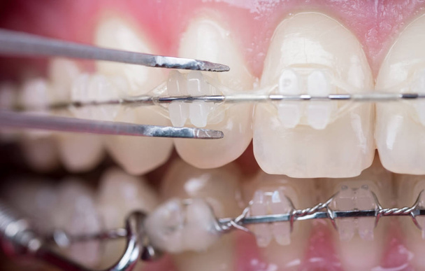 Tandarts controle tanden met keramische haakjes, met behulp van omgekeerde pincet bij de tandheelkundige kantoor. Macro-opname van tanden met bretels. Orthodontische behandeling. Tandheelkunde - Foto, afbeelding