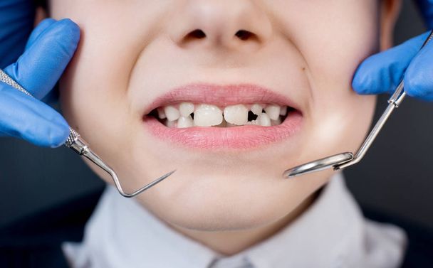 Хлопчик, що показує зуби на стоматологічному огляді. Крупним планом рука стоматолога за допомогою зубних інструментів - зонд і дзеркало в стоматологічному кабінеті. стоматології
 - Фото, зображення
