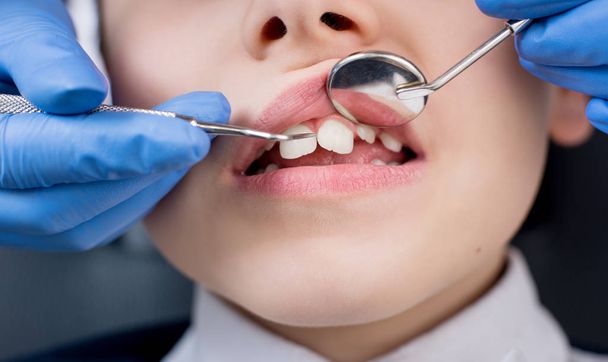 Крупный план руки стоматолога, осматривающего зубы мальчика-пациента в стоматологической клинике с помощью зубных инструментов - зонда и зеркала. Стоматология
 - Фото, изображение