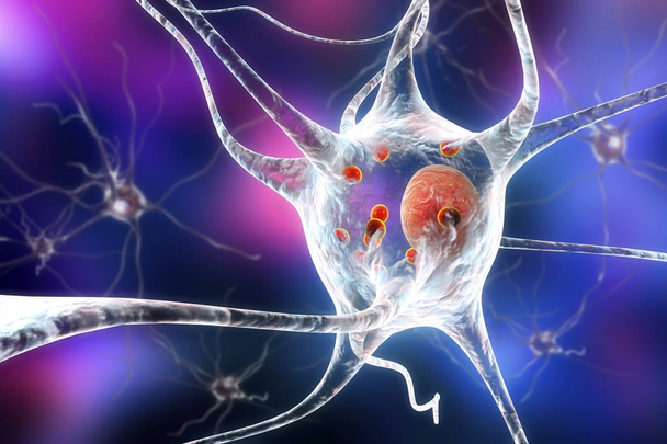 Neurons in Parkinson's disease - Photo, Image