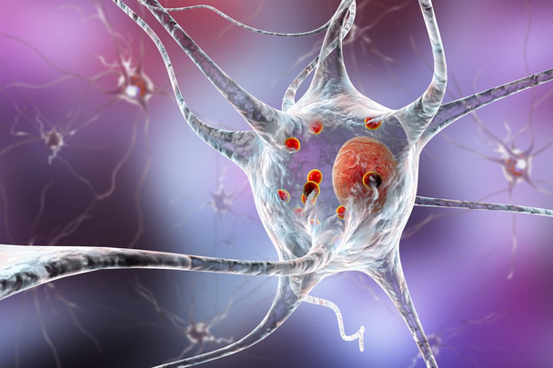Neuronen die in ziekte Parkinson's - Foto, afbeelding