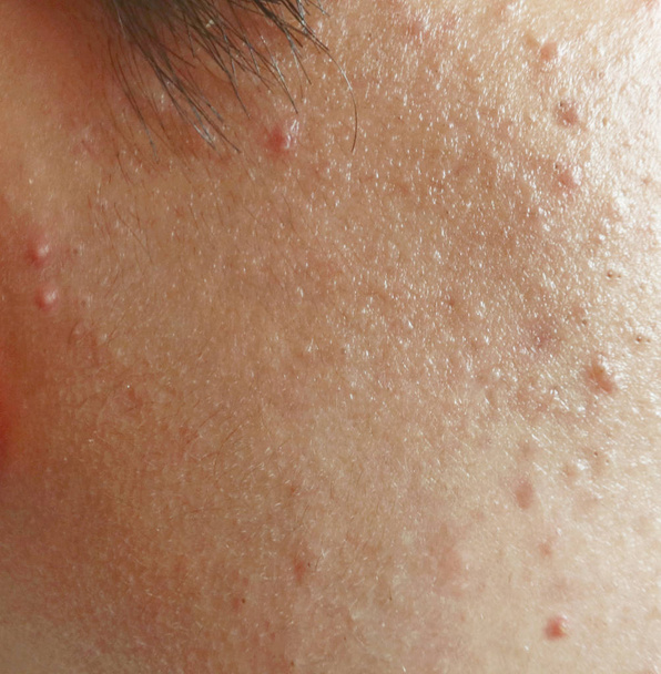 Rash on sensitive skin - Photo, Image