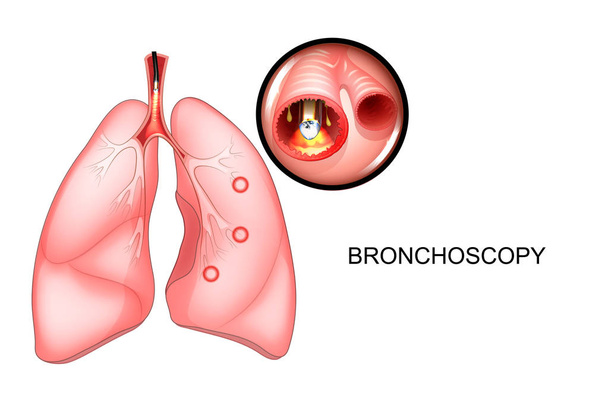 broncoscopia de los pulmones, vista seccional
 - Vector, imagen