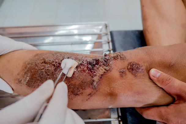 Closeup infekce rány na noze pacientů  - Fotografie, Obrázek