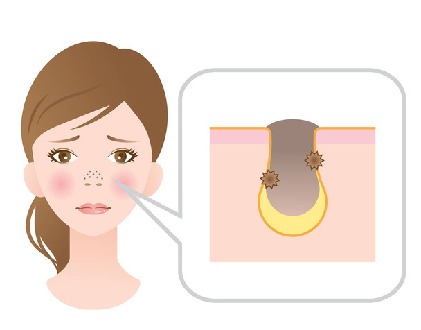 poros obstruidos en la cara femenina
 - Vector, Imagen