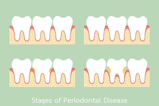 etapa da doença periodontal / periodontite / gengivite / doença gengival, problema dentário
 - Vetor, Imagem