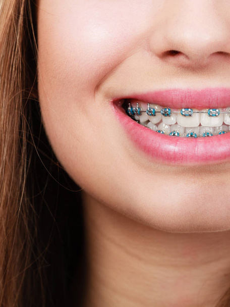 Mujer mostrando sus dientes con aparatos ortopédicos
 - Foto, Imagen