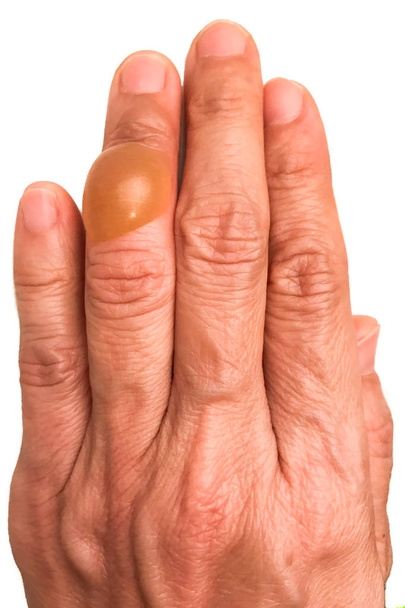 Nahaufnahme am Finger mit schmerzhafter, mit Flüssigkeit gefüllter Blase - Foto, Bild