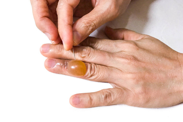 Detail, píchání bolestivé zánětlivé tekutiny puchýř prst s sh - Fotografie, Obrázek