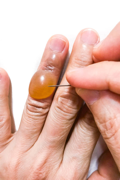 Detail, píchání bolestivé zánětlivé tekutiny puchýř prst s sh - Fotografie, Obrázek