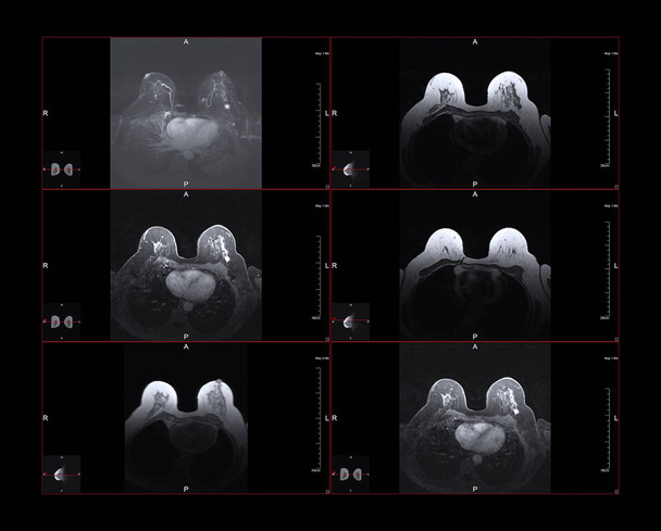 Rezonansu magnetycznego piersi, lub Mri. Białe plamki w większych obrazów jest jednym etapie raka piersi. - Zdjęcie, obraz