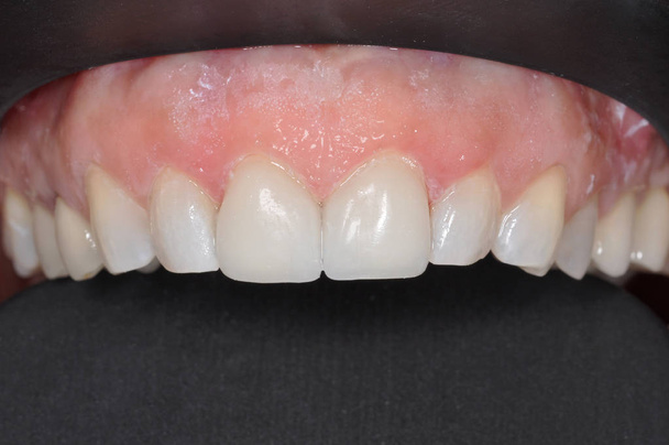 Close up van de bovenste rij van een patiënt van tanden bij een tandheelkundige kliniek - Foto, afbeelding