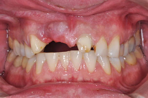 Close up da boca de um paciente sem dente na clínica odontológica
 - Foto, Imagem