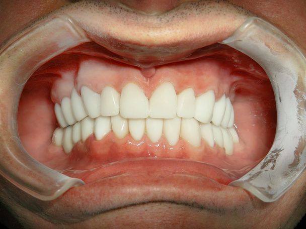 Primo piano della bocca di un paziente in una clinica dentistica - Foto, immagini