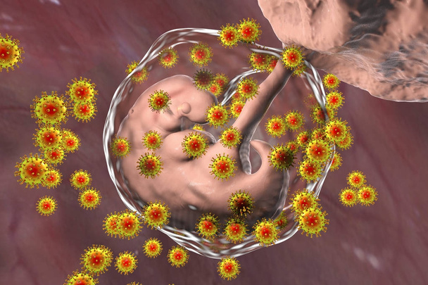 Transmisión perinatal de la infección por VIH, imagen conceptual
 - Foto, imagen