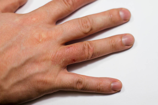 Hand dermatitis. Hand eczeem - Foto, afbeelding