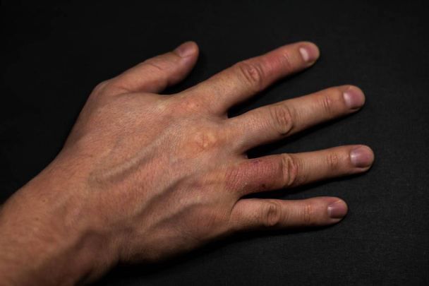Dermatitis de manos. Eczema de mano
 - Foto, Imagen